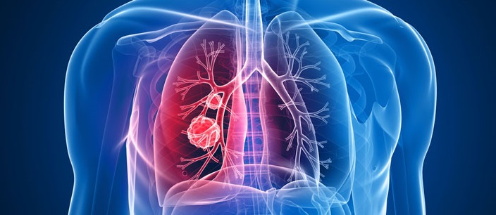 Cancer bronho-pulmonar - CAZ